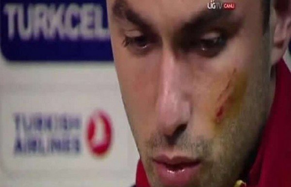 'Burak Yılmaz'ın yüzü bu hale geldi!
