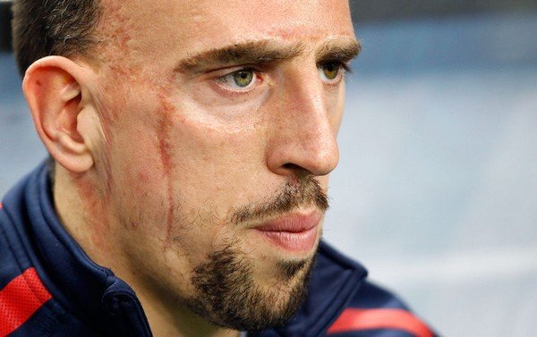Ribery - Scarface (Yaralı yüz)