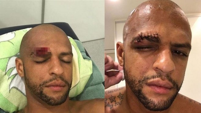 Felipe Melo’ya nazar değdi!