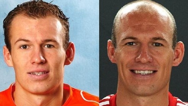 Bir zamanlar saçları vardı